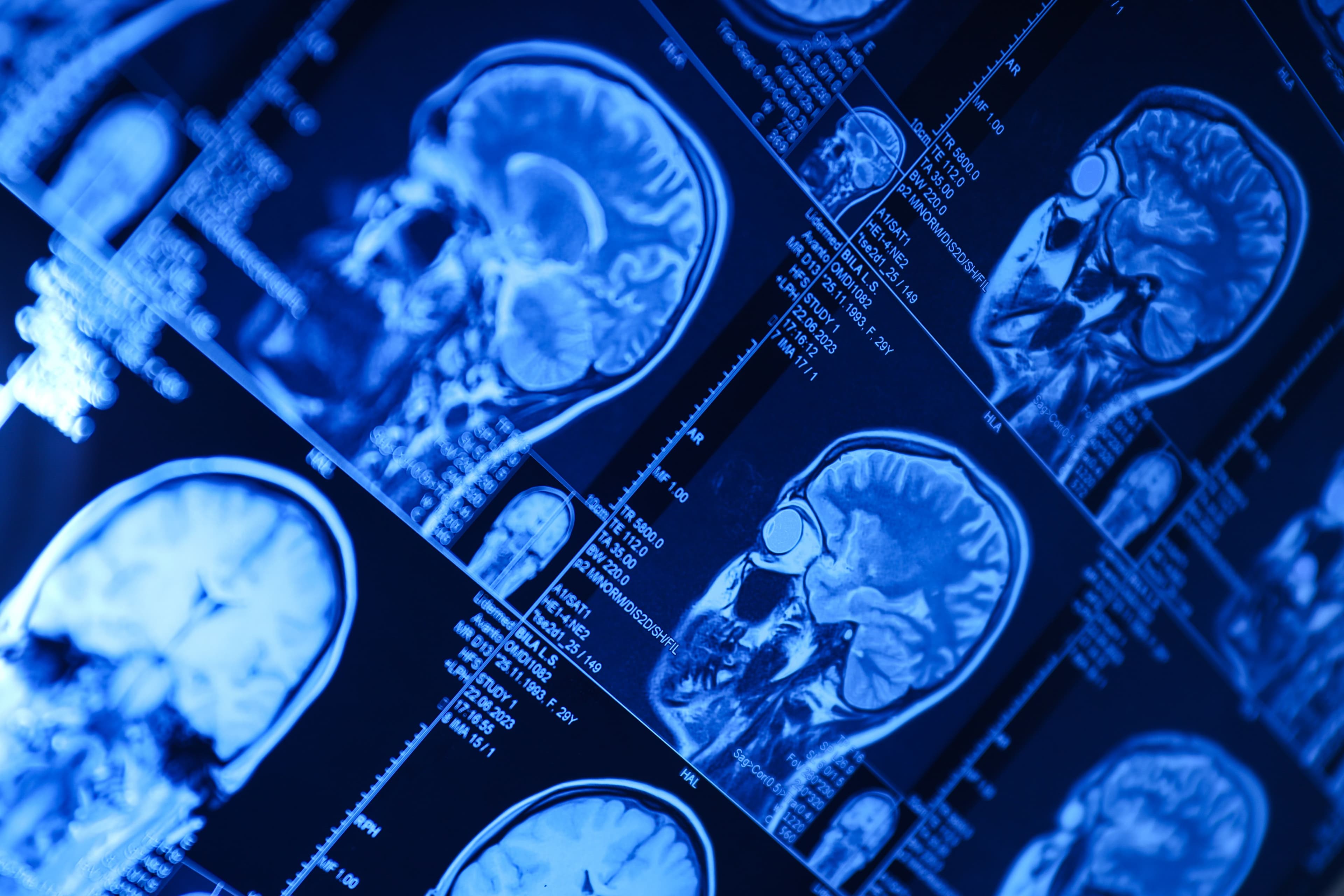 How Long Does It Take to Recover From a Traumatic Brain Injury?