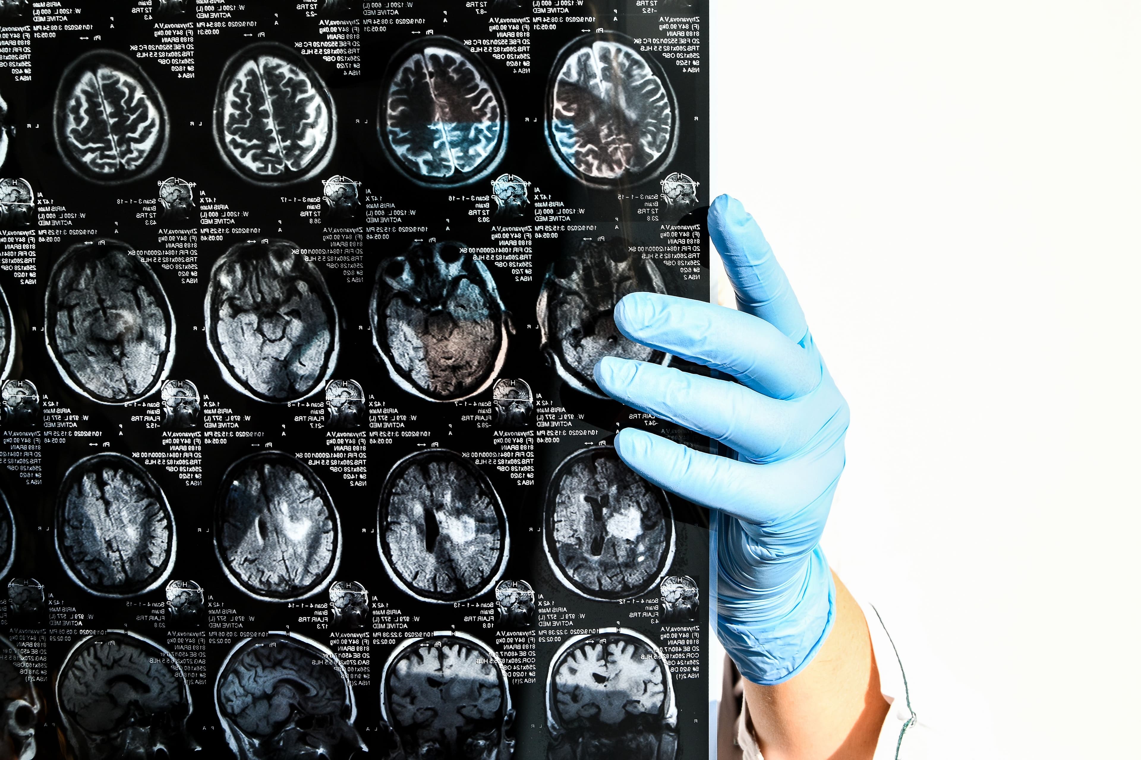 Why It Matters to Hire a Lawyer Who Understands Brain Injuries