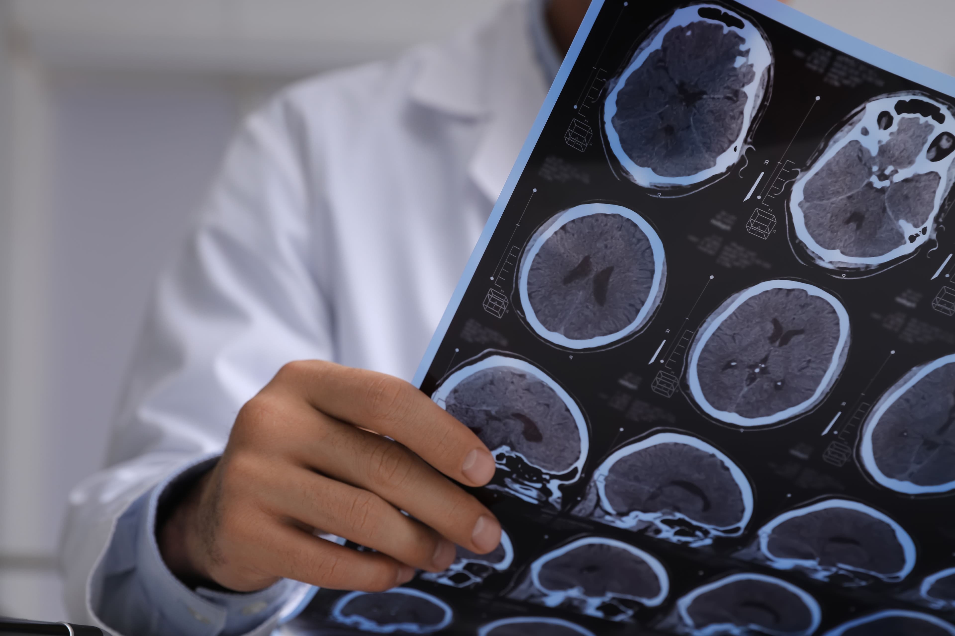 Common Causes of Traumatic Brain Injuries